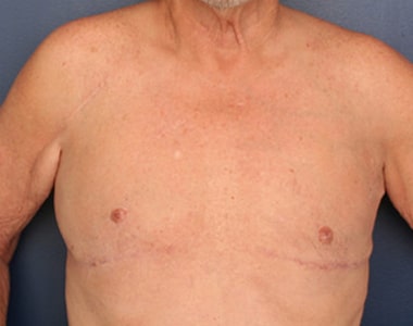 After Image: Gynecomastia - front