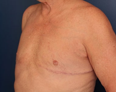 After Image: Gynecomastia - left-front-oblique