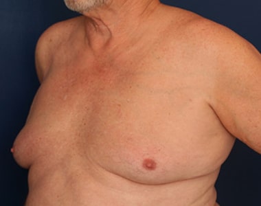 Before Image: Gynecomastia - left-front-oblique