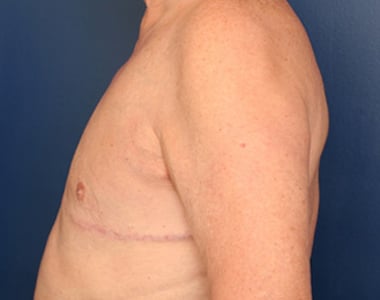 After Image: Gynecomastia - left-side