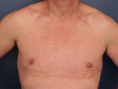 After Image: Gynecomastia - front