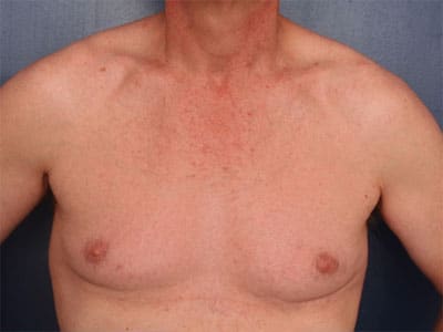 Before Image: Gynecomastia - front