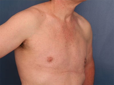 After Image: Gynecomastia - right-front-oblique