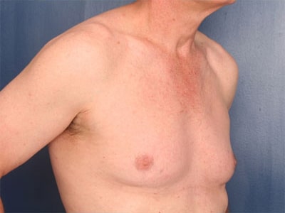 Before Image: Gynecomastia - right-front-oblique