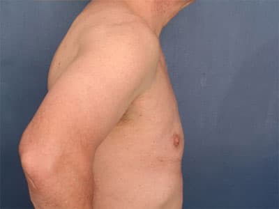 After Image: Gynecomastia - right-side