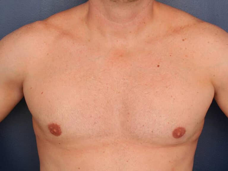 After Image: Gynecomastia - front