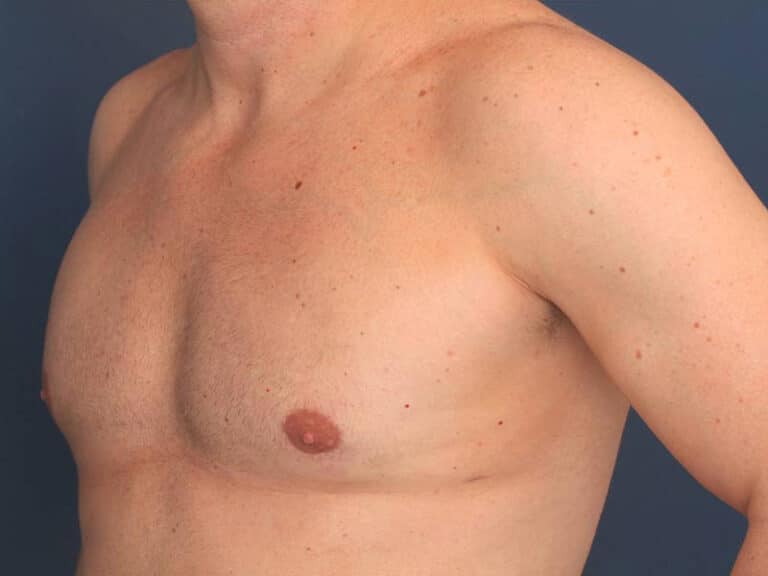 After Image: Gynecomastia - left-front-oblique
