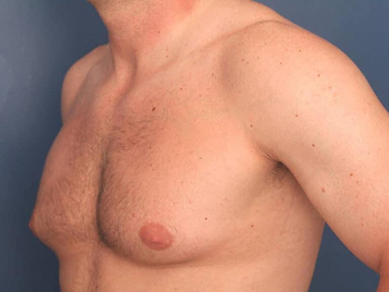 Before Image: Gynecomastia - left-front-oblique
