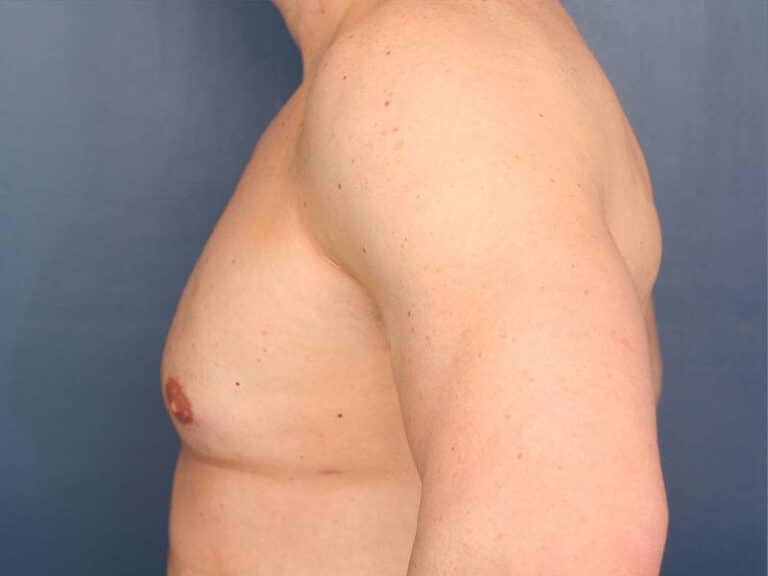 After Image: Gynecomastia - left-side