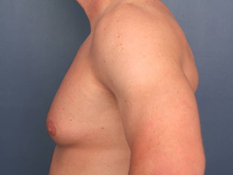 Before Image: Gynecomastia - left-side