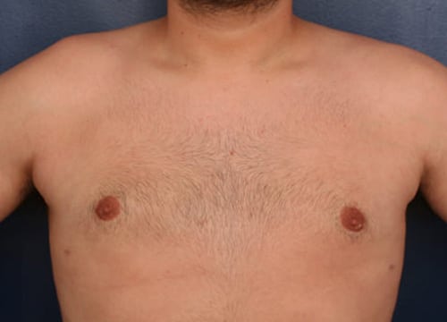 After Image: Gynecomastia - front