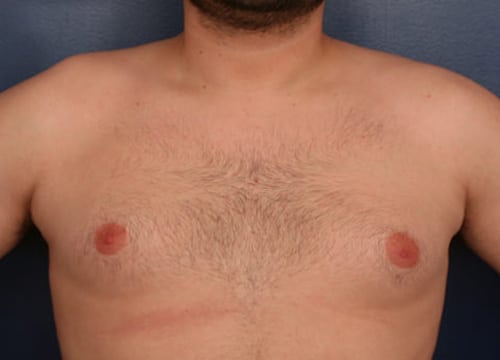 Before Image: Gynecomastia - front