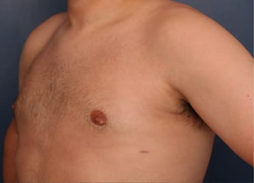 After Image: Gynecomastia - left-front-oblique
