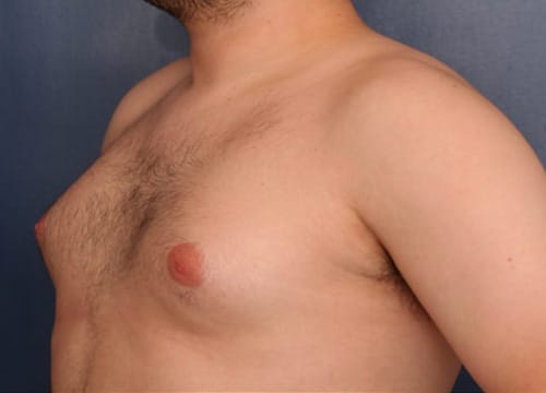 Before Image: Gynecomastia - left-front-oblique