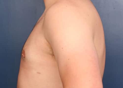 After Image: Gynecomastia - left-side
