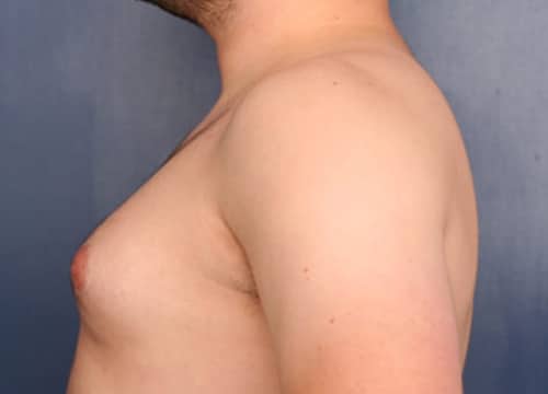 Before Image: Gynecomastia - left-side