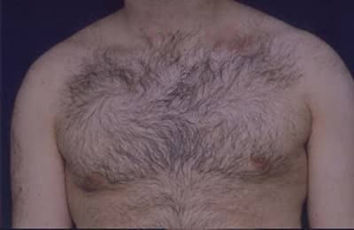 After Image: Gynecomastia - front