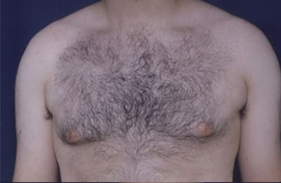 Before Image: Gynecomastia - front