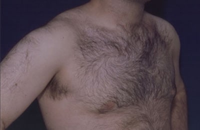 After Image: Gynecomastia - right-front-oblique