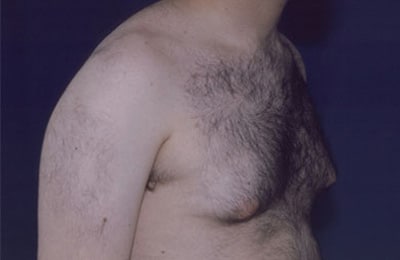 Before Image: Gynecomastia - right-front-oblique