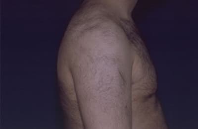 After Image: Gynecomastia - right-side