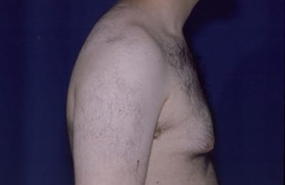 Before Image: Gynecomastia - right-side