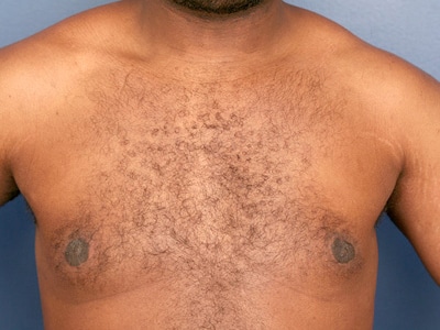 After Image: Gynecomastia - front