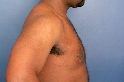 After Image: Gynecomastia - right-side