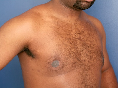 After Image: Gynecomastia - right-front-oblique