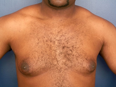 Before Image: Gynecomastia - front