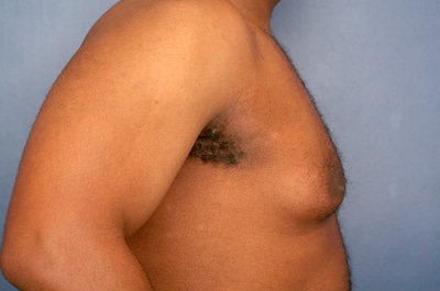 Before Image: Gynecomastia - right-side