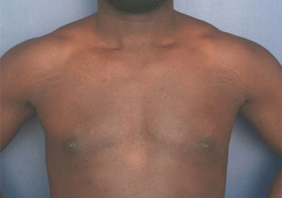 After Image: Gynecomastia - front
