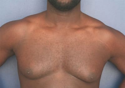 Before Image: Gynecomastia - front