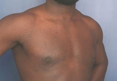 After Image: Gynecomastia - right-front-oblique