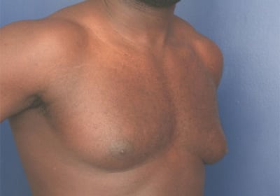 Before Image: Gynecomastia - right-front-oblique