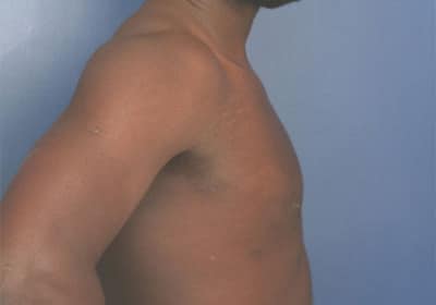 After Image: Gynecomastia - right-side