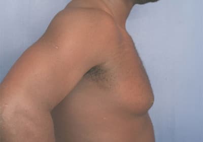 Before Image: Gynecomastia - right-side