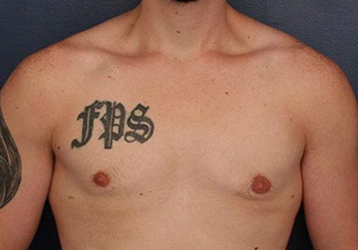 After Image: Gynecomastia - front