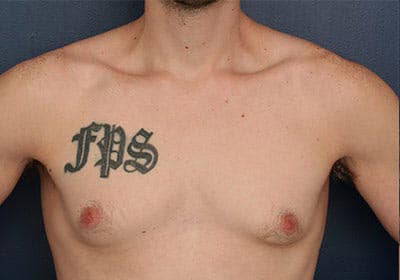 Before Image: Gynecomastia - front