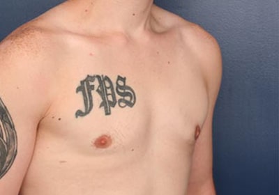 After Image: Gynecomastia - right-front-oblique