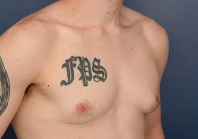 Before Image: Gynecomastia - right-front-oblique