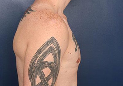 After Image: Gynecomastia - right-side