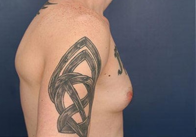 Before Image: Gynecomastia - right-side