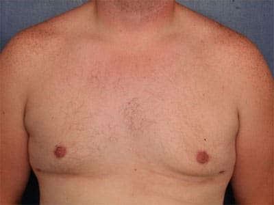 After Image: Gynecomastia - front