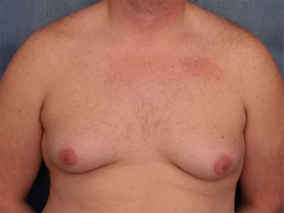 Before Image: Gynecomastia - front