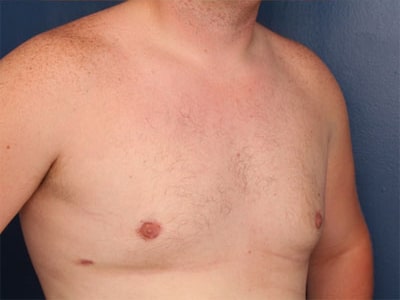 After Image: Gynecomastia - right-front-oblique