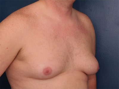 Before Image: Gynecomastia - right-front-oblique