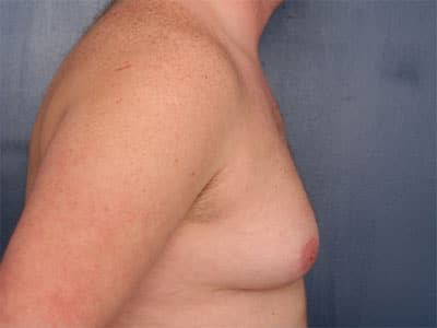 Before Image: Gynecomastia - right-side