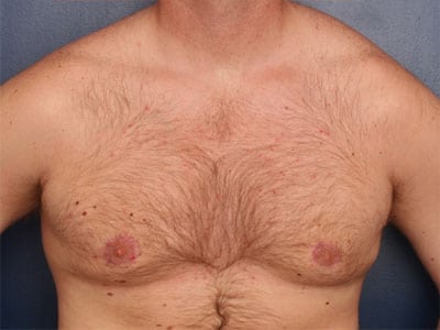 After Image: Gynecomastia - front