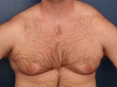 Before Image: Gynecomastia - front